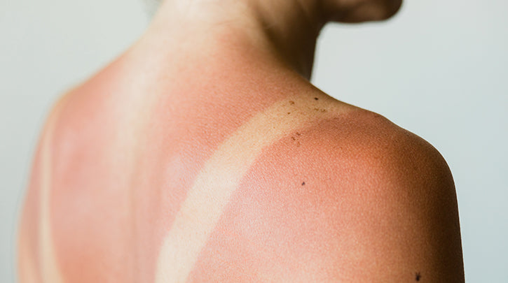 How to Care for Your Skin After Sun Exposure