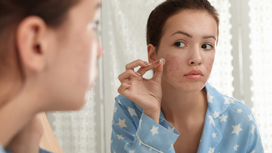 How to Choose the Best Products for Managing Acne Scars