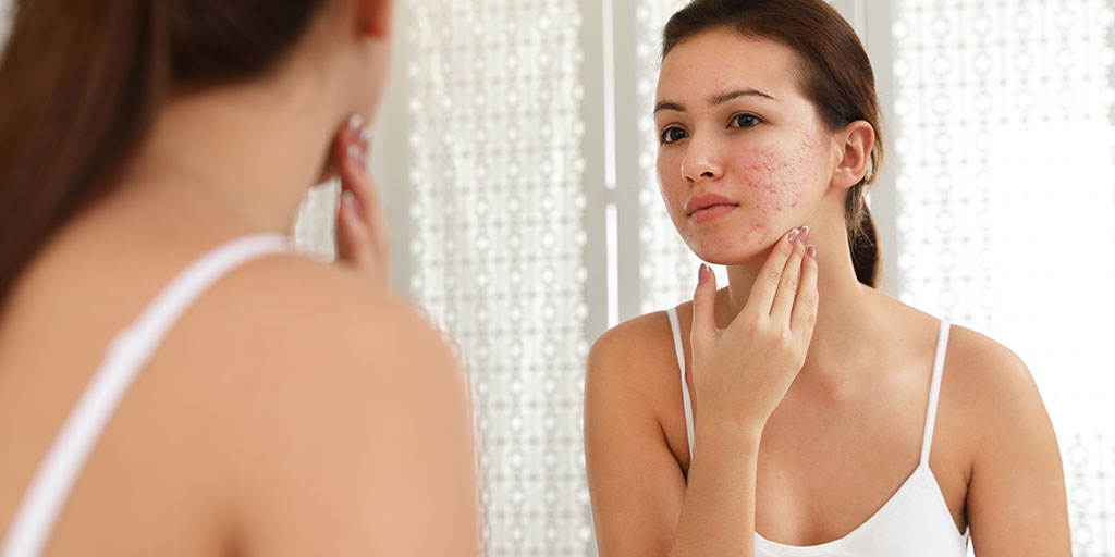 How to Treat Acne and Acne Scars in UAE's Climate
